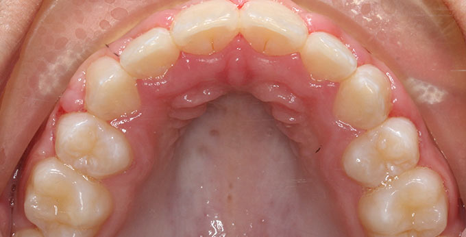 After Orthodontic treatment consisting of removal of four premolar teeth followed by Upper braces.